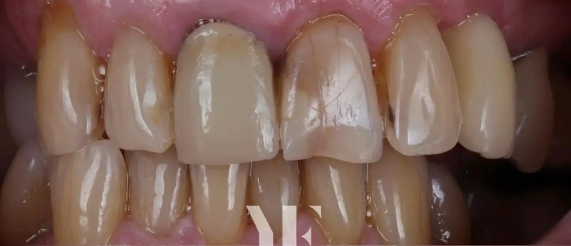 Before Smile Makeover